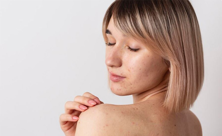 استفاده بیشازحد از محصولات مراقبت پوست میتواند باعث جوش شود